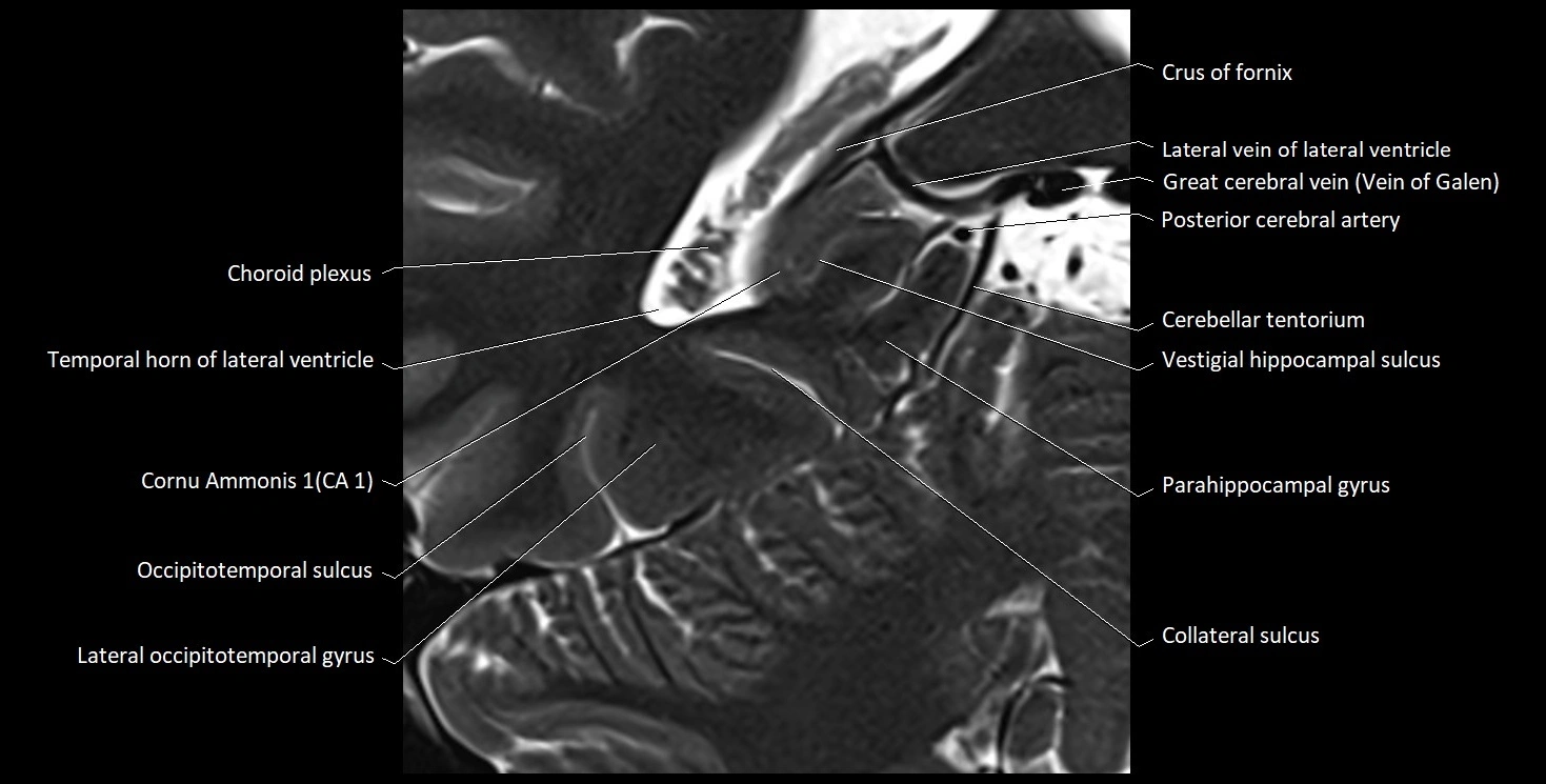 Hippocampus anatomy mri coronal cross section 3T MRI image 18.webp